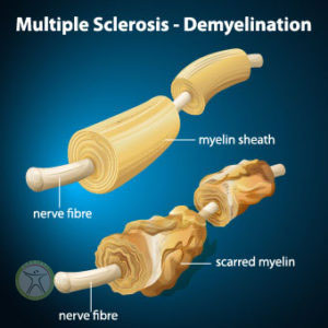 کنترل و درمان ام اس یا مالتیپل اسکلروزیس MS multiple sclerosis+فیزیوتراپی پیشرفته شریعتی