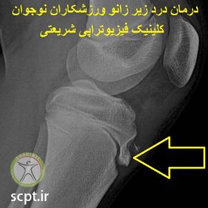ازگود اشلاتر-بیرون زدگی استخوان زیر زانو در ورزشکاران نوجوان-درد استخوان درشت نی-علائم تشخیص و درمان-فیزیوتراپی شریعتی