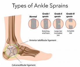 http://scpt.ir/uploads/types-of-ankle-sprain.png