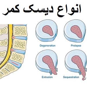 انواع-دیسک-کمر-فیزیوتراپی-شریعتی-دکتر-رضایی