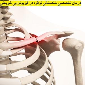 شکستگی-ترقوه
