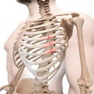 شکستگی-دنده