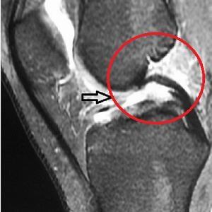 photo-of-cruciate-ligament-rupture
