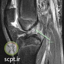 http://scpt.ir/uploads/ACL TEAR reconstruction rehab.jpg