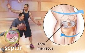 http://scpt.ir/uploads/Meniscus-injury-tear.jpg