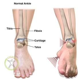 http://scpt.ir/uploads/Osteochondritis-Dissecans-OCD-Talus-ankle-mechanism-1.jpg