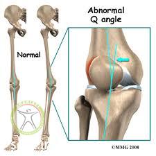 http://scpt.ir/uploads/Q angle alighnment chondromalacia.jpg