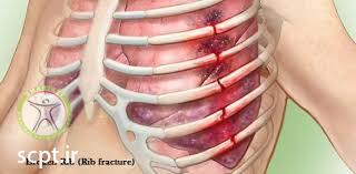 http://scpt.ir/uploads/Rib fracture injury number of ribs.jpg