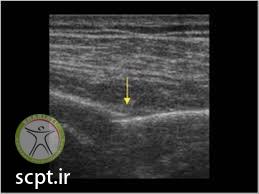 http://scpt.ir/uploads/Rib fracture injury sonography.jpg
