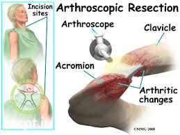 acromioclavicular joint djd shariati