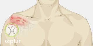 acromioclavicular joint step deformity shariati