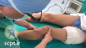 http://scpt.ir/uploads/acl reconstruction principle.jpg