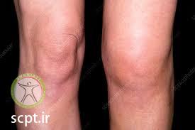 http://scpt.ir/uploads/acl tear hemarthrosis.jpg