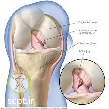 http://scpt.ir/uploads/acl tear.jpg