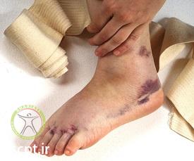 http://scpt.ir/uploads/ankle-sprain-2.jpg