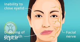 bells balsy shariati seyedkhandan treatment