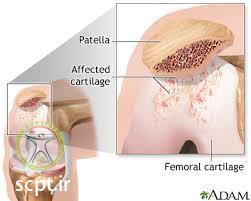 http://scpt.ir/uploads/chondromalacia 1.jpg