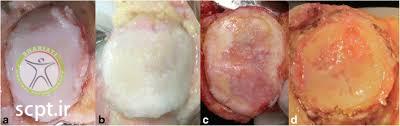 http://scpt.ir/uploads/chondromalacia knee.jpg