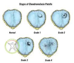 http://scpt.ir/uploads/chondromalacia stage.jpg