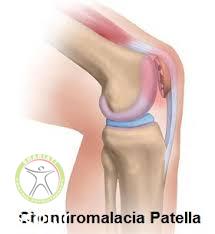 http://scpt.ir/uploads/chondromalacia.jpg