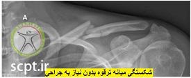http://scpt.ir/uploads/clavicle-fracture-midshaft.jpg