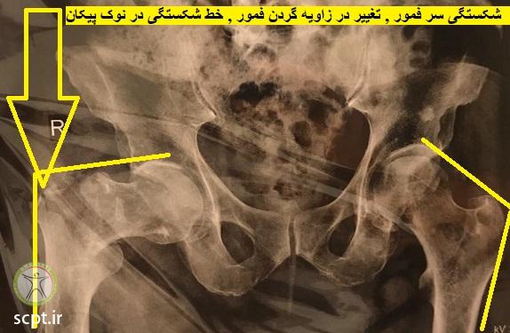 http://scpt.ir/uploads/femoral-head-fracture-4.jpg