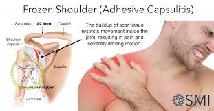 frozen shoulder shariati seyedkhandan 