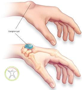 http://scpt.ir/uploads/ganglion-cyst.jpg
