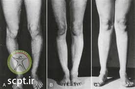 geno varus valgus shariati