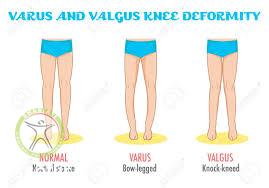 geno varus valgus shariati