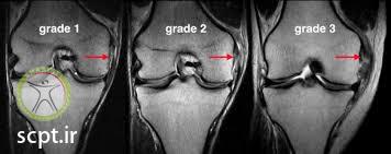 http://scpt.ir/uploads/grade injury mcl torn.jpg