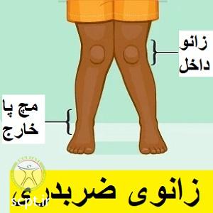 http://scpt.ir/uploads/knock-knees-1.jpg