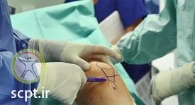 http://scpt.ir/uploads/knock-knees-surgery.jpg