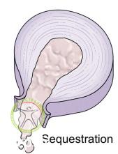 http://scpt.ir/uploads/low-back-pain-lumbar-disc-herniation-classification-sequestration.jpg