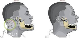 http://scpt.ir/uploads/mandibular protrusion.jpg