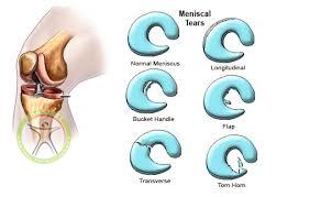 http://scpt.ir/uploads/meniscus tear type 2.jpg