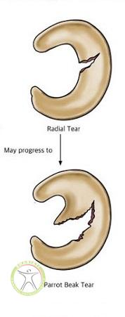 http://scpt.ir/uploads/meniscus-injury-tear-types-2.jpg