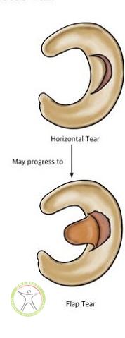 http://scpt.ir/uploads/meniscus-injury-tear-types-3.jpg