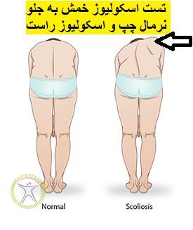 http://scpt.ir/uploads/normal_vs_scoliosis.jpg