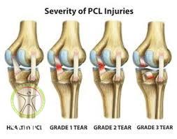 http://scpt.ir/uploads/pcl-tear-grades.jpg