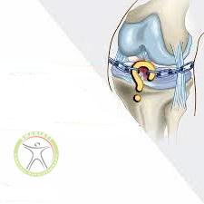 http://scpt.ir/uploads/photo-of-cruciate-ligament-rupture-6.jpg