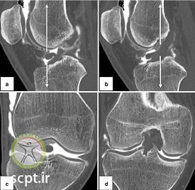 http://scpt.ir/uploads/photo-of-cruciate-ligament-rupture-7.jpg