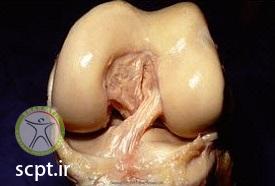http://scpt.ir/uploads/photo-of-cruciate-ligament-rupture-8.jpg