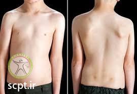 http://scpt.ir/uploads/scoliosis-assessment.jpg