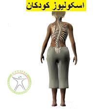 http://scpt.ir/uploads/scoliosis-child.jpg