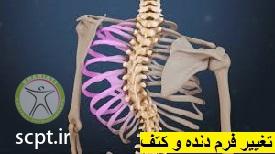 http://scpt.ir/uploads/scoliosis-deformity-chest.jpg