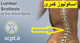 http://scpt.ir/uploads/scoliosis-lumbar.jpg