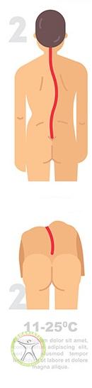 http://scpt.ir/uploads/scoliosis-types-2.jpg