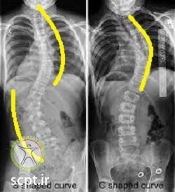 http://scpt.ir/uploads/scoliosis-types.jpg