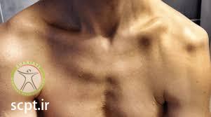 http://scpt.ir/uploads/shoulder dislocation 2.jpg
